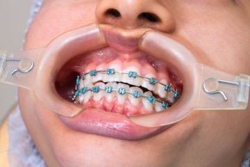 dental braces