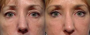 The Rising Trend of Upper and Lower Eyelid Surgery in New York City, NY