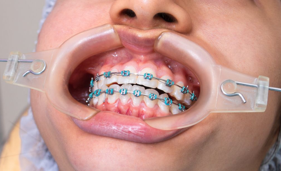 dental braces